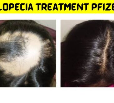 Alopecia Treatment Pfizer