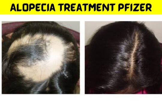 Alopecia Treatment Pfizer