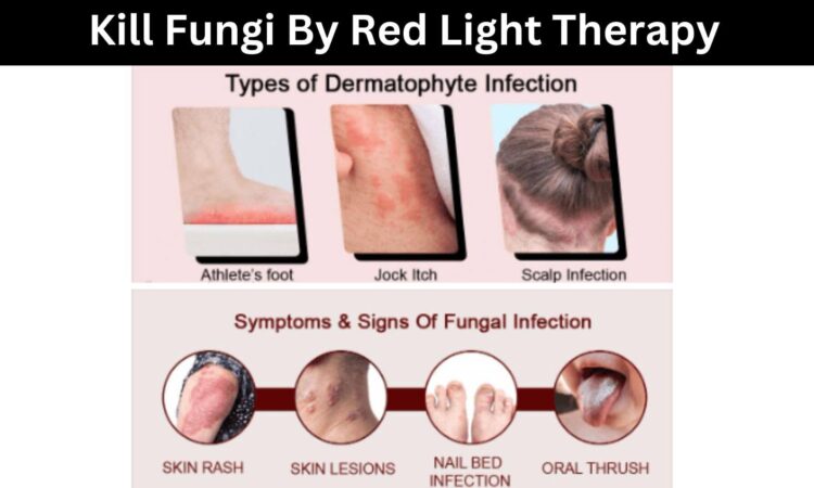 Kill Fungi By Red Light Therapy